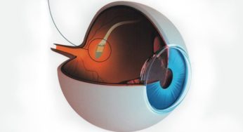 Impiantato microchip sotto la retina contro la cecità, primo intervento in Italia