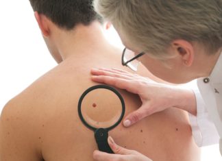cos'è un melanoma