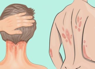 Psoriasi