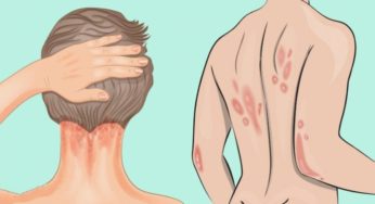 Psoriasi: cos’è e come riconoscerla