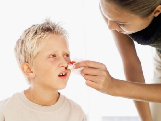Cosa Fare Quando Perdi Sangue Dal Naso