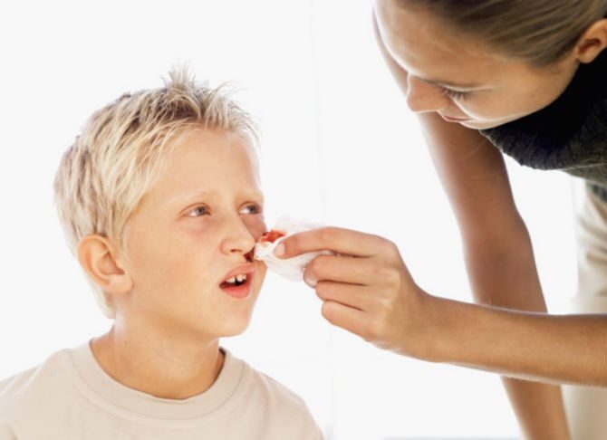 Sangue dal naso bambini o epistassi, quando preoccuparsi?