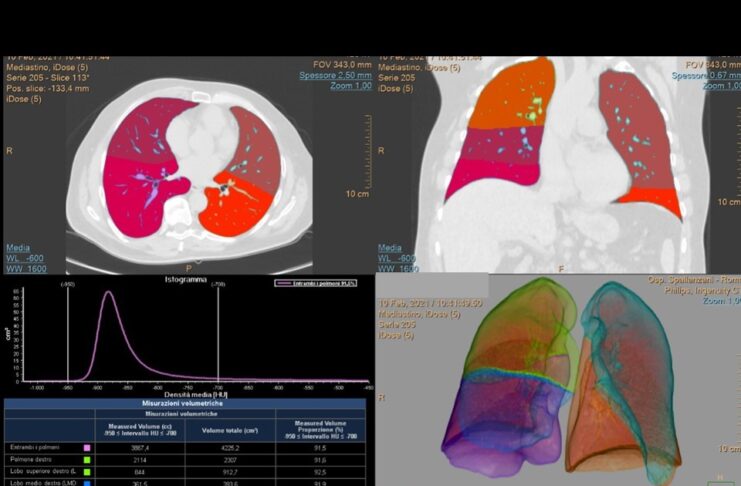 Segmentazione polmonare con mappe colorimetriche e valutazione dei volumi polmonari delle aree normalmente aereate e di quelle colpite dalla polmonite nelle varie fasi.