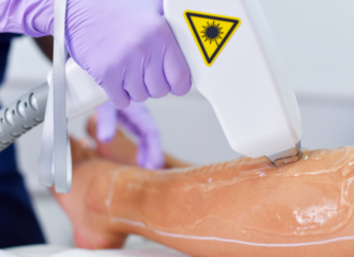 epilazione-laser-diodo