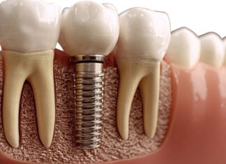 5 domande da fare al dentista prima di un impianto dentale Implantologia