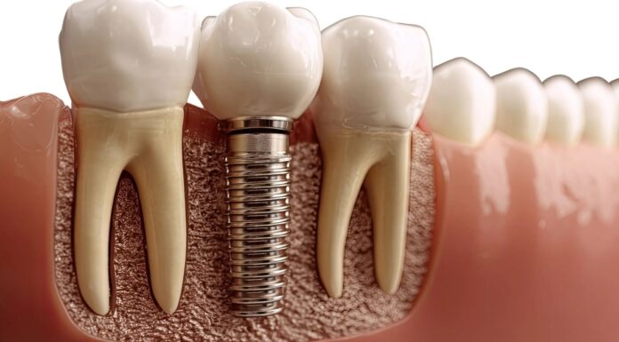 5 domande da fare al dentista prima di un impianto dentale Implantologia